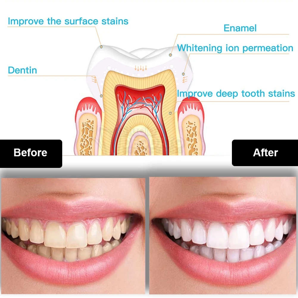 Dental Teeth Whitening Kit Min - مراجعة Teeth Whitening With Trays وسعره