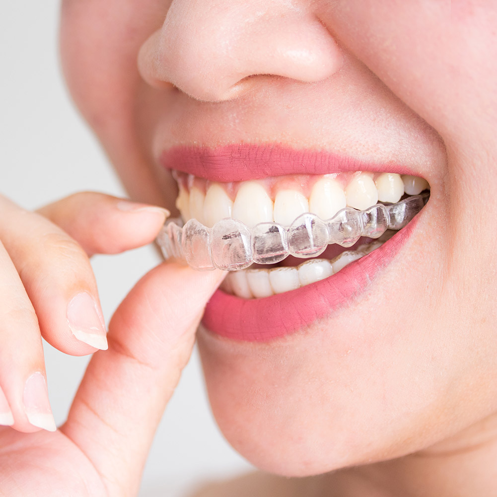 2/4pcs Mouth Guard Teeth Prote - مراجعة Teeth Whitening With Trays وسعره